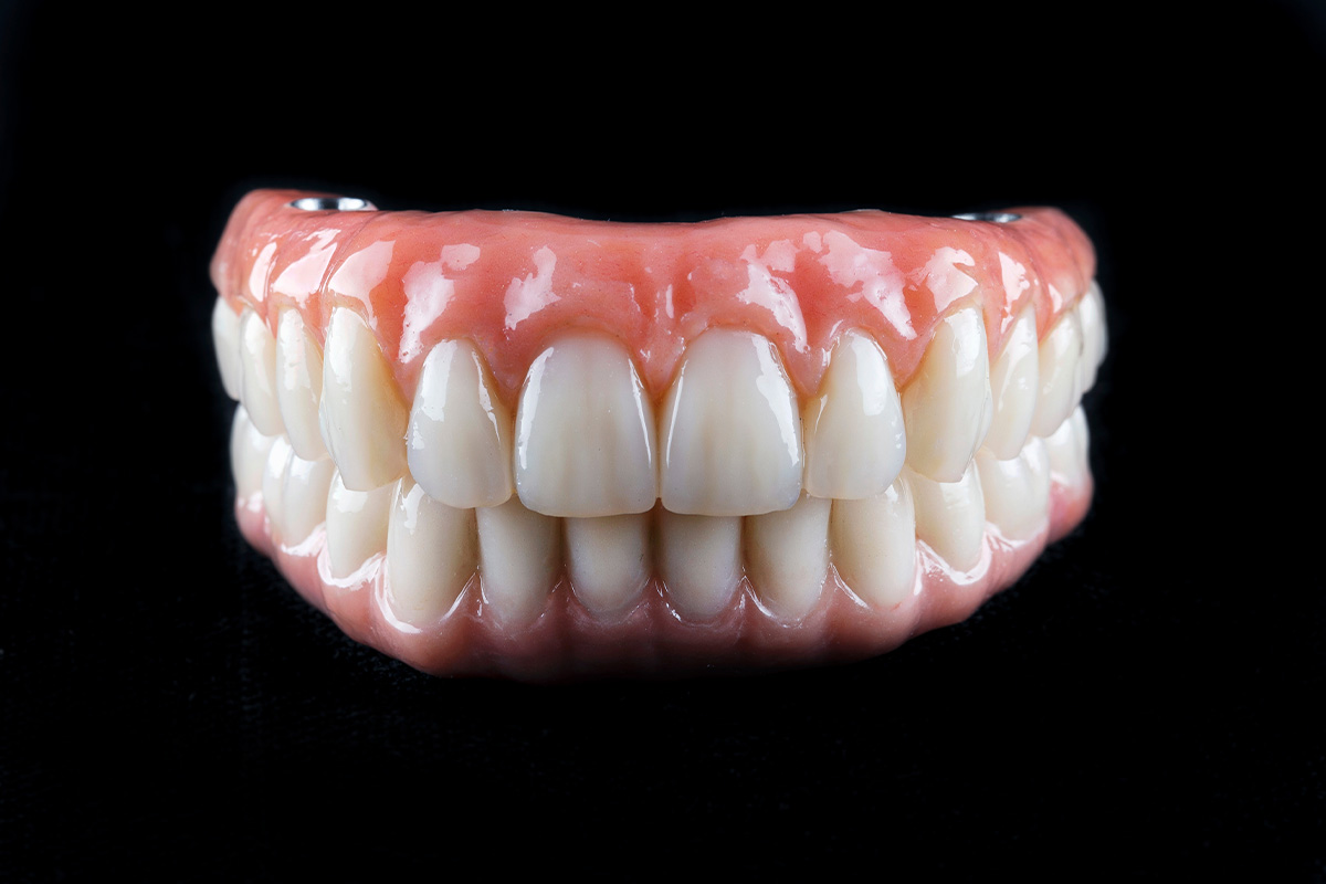 All-on-4 i All-on-6 fiksni rad na implantatima