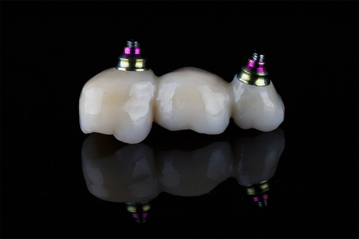 Most na implantatima